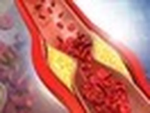Ăn chay 15 năm, gầy như "xác ve" nhưng mỡ máu vẫn cao: Nguyên nhân là thứ nhiều người không ngờ tới