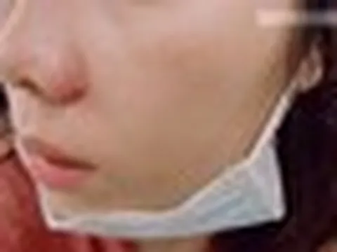 Nặn mụn quanh miệng, người phụ nữ bị sưng tấy từ môi lên tận sống mũi, bác sĩ cảnh báo: Sai lầm ở 1 điểm!